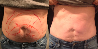 CoolSculpting before and after photo