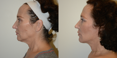 Facelift before and after photo