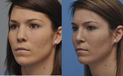 Revision Rhinoplasty before and after photo