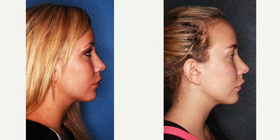 Rhinoplasty before and after photo