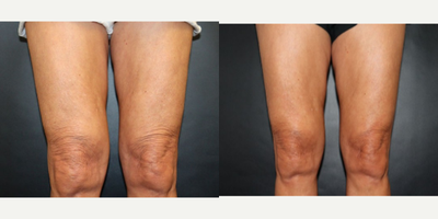 Thermage before and after photo
