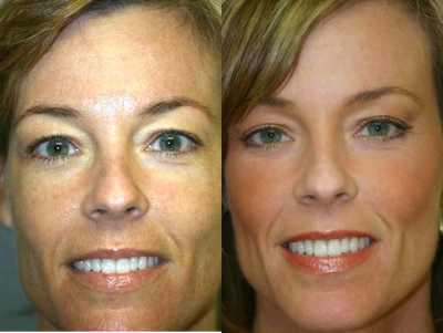 CO2 Laser before and after photo