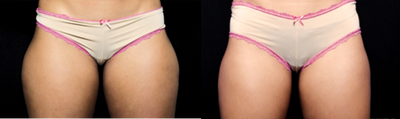 CoolSculpting before and after photo