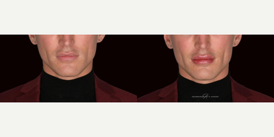 Lip Fillers before and after photo