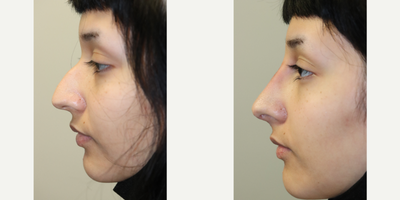 Nonsurgical Nose Job before and after photo