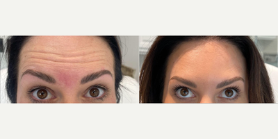 Botox before and after photo