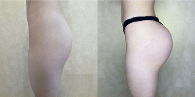 Butt Augmentation before and after photo