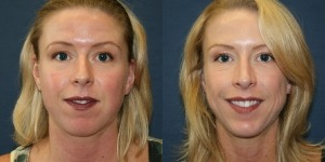 Chin Implant before and after photo