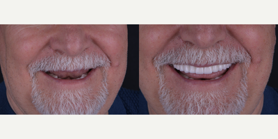 Dental Crown before and after photo
