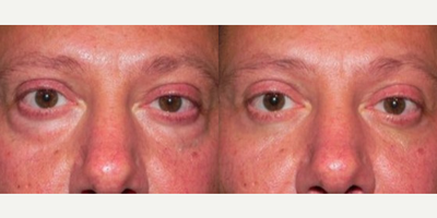 Dermal Fillers before and after photo
