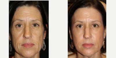 Facial Fat Transfer before and after photo