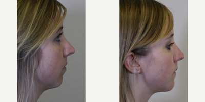 Genioplasty before and after photo