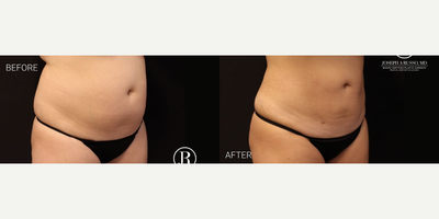 Liposuction before and after photo