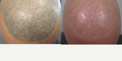 PicoSure before and after photo