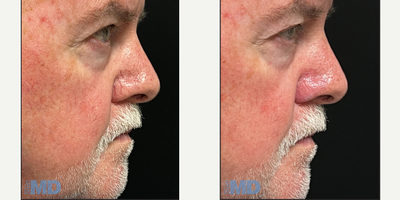 Skin Rejuvenation before and after photo