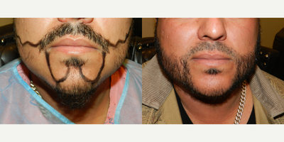 Beard Transplant before and after photo