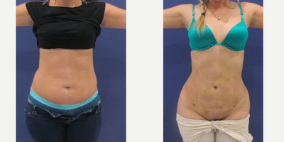 Liposuction before and after photo