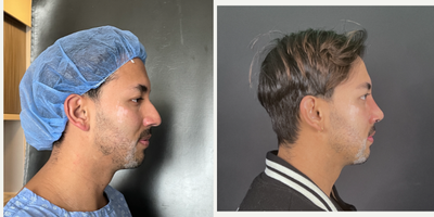 Rhinoplasty before and after photo