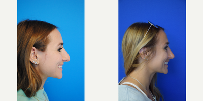 Septoplasty before and after photo