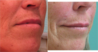 Juvederm before and after photo