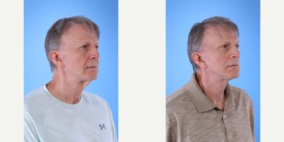 before and after image