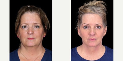 Neck Lift before and after photo