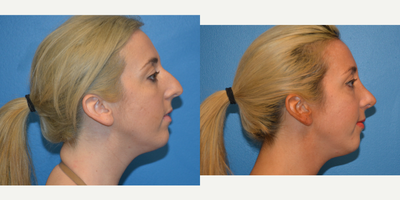Rhinoplasty before and after photo