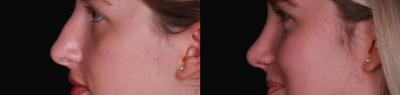 Rhinoplasty before and after photo