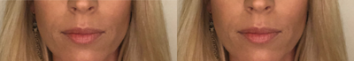 Dermal Fillers before and after photo