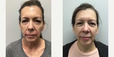 Dermal Fillers before and after photo