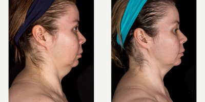 SculpSure before and after photo