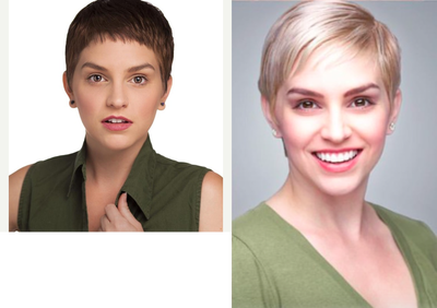 Smile Makeover before and after photo