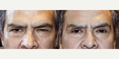 Double Eyelid Surgery before and after photo