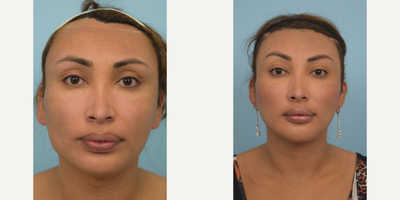Facial Feminization Surgery before and after photo