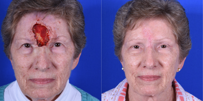 Facial Reconstructive Surgery before and after photo