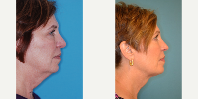 Ultherapy before and after photo