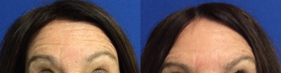 Botox before and after photo