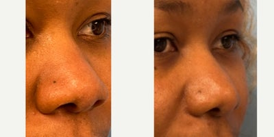 Rhinoplasty before and after photo