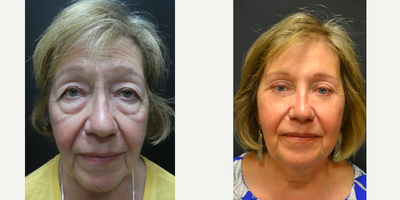 Eyelid Surgery before and after photo