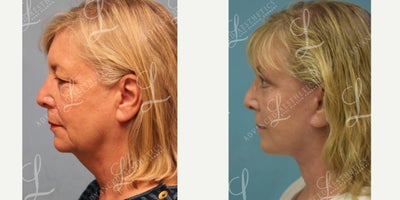 Eyelid Surgery before and after photo