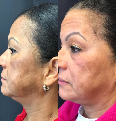 Fraxel Laser before and after photo