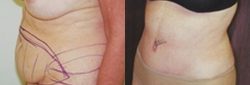 Liposuction before and after photo