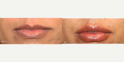 Restylane before and after photo