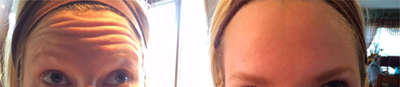 Botox before and after photo