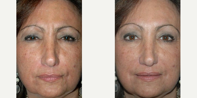 Botox before and after photo