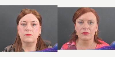 Double Eyelid Surgery before and after photo