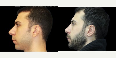 Ear Surgery before and after photo