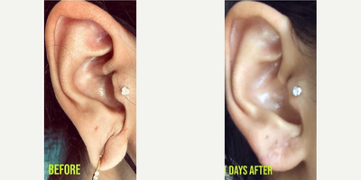 Earlobe Repair before and after photo