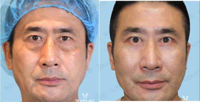 Eyelid Surgery before and after photo