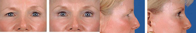 Eyelid Surgery before and after photo